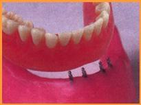 Mini Implants for dentures
